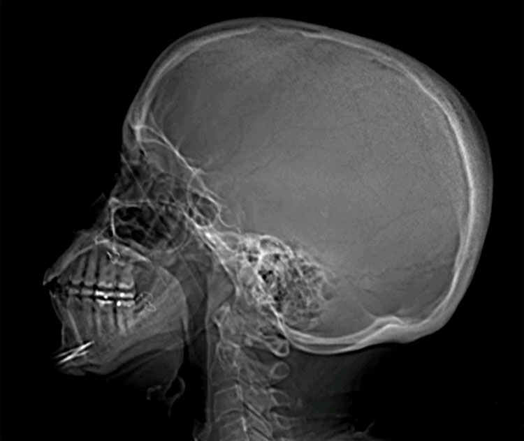 Radiographie traumatisme cranien